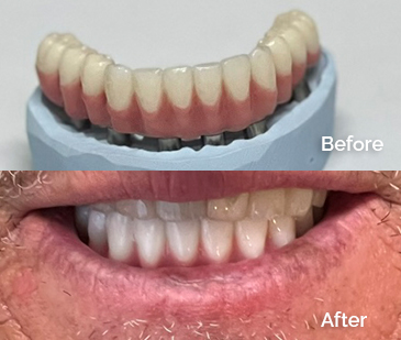 Hybrid Denture Before and After 1