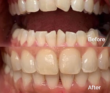 Invisalign Before and After 1
