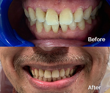 Invisalign Before and After 3