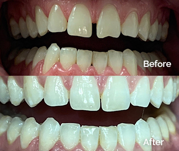 Invisalign Before and After 6