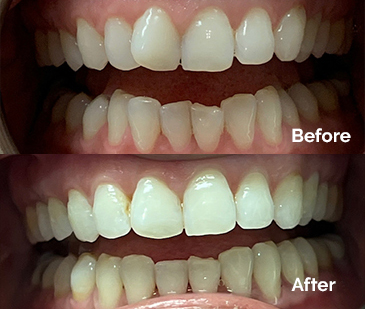 Invisalign Before and After 7