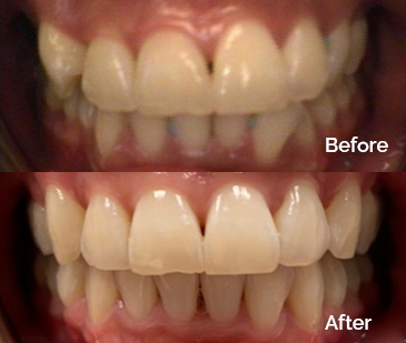 Invisalign Before and After 8