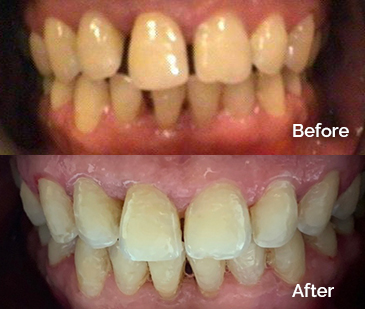 Invisalign Before and After 9