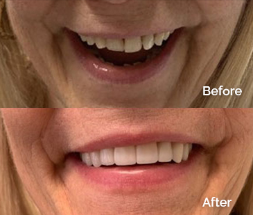 Porcelain Crowns Before and After