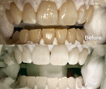 Zoom Teeth Whitening Before and After 2