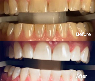 Zoom Teeth Whitening Before and After 1