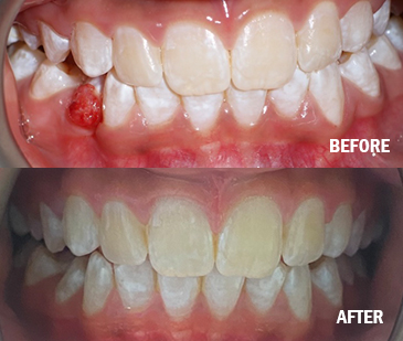 Before And After With Removable Appliances 1