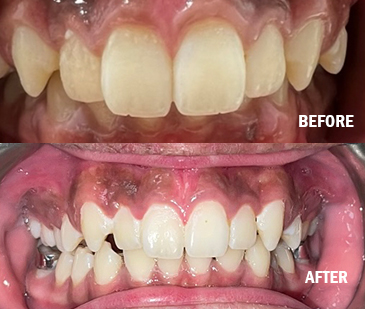 Before And After With Fixed Appliance
