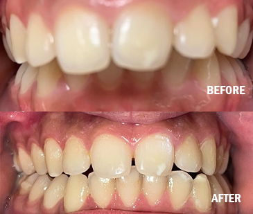 Before And After With Removable Appliances 2