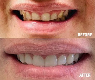 Smile Makeover Before and After 2