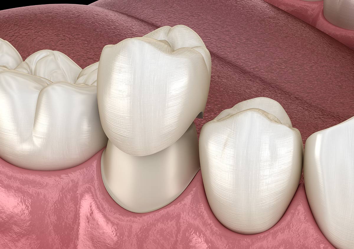Explore the benefits of dental crowns at Modern Dental Studio in East Brunswick, NJ